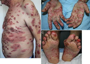 A–C, Very extensive bullous pemphigoid eruption in a 69-year-old man on combined durvalumab and tremelimumab treatment for stage IV nonsmall cell lung cancer. Lesions persisted even after treatment was interrupted.