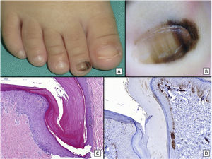 Congenital subungual melanocytic nevus. A, A 15-month-old girl consulted for longitudinal melanonychia affecting the second toe of the right foot. The clinical examination revealed a wide band of longitudinal melanonychia, with various lines with pigmentation of different colors, which extended to the proximal nail fold. B, Dermoscopy confirms the clinical findings: a band of almost total melanonychia can be seen, with lines of different thicknesses and pigment colors. Also visible is light pigmentation in both the proximal nail fold and the lateral nail fold. All of these signs would be considered cause for alarm in an adult. C, Oblique section of the nail and surrounding tissues showing acral epithelium with a proliferation of melanocytes in the basal layer of the epithelium arranged in nests, with no atypical cellular characteristics. D, Staining with HMB45 confirms the proliferation to be melanocytic, as well as its distribution in nests.