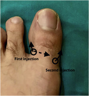Performing the H technique. First injection at the dorsal level in the peroneal canal, directed underneath the long extensor of the great toe and then towards the plantar region. The second injection is performed in the dorsum of the great toe in the tibial canal directing the needle towards the plantar region.