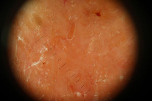 Imagen dermatoscópica.