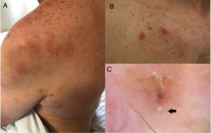 A) Exantema por COVID-19 en el hombro izquierdo y nódulos escabióticos en axila. B) Nódulos escabióticos. C) Imagen dermatoscópica del Sarcoptes scabiei var hominis, la flecha señala el ácaro.