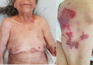 Manifestaciones clínicas: erosiones múltiples presentes en tronco, brazos, cuello, nalgas y muslos.