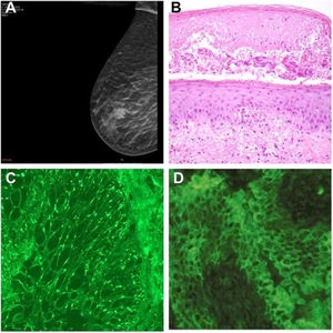 A) Mamografía que revela un tumor en la mama derecha. B) Histopatología que revela formación de vesículas con zonas de formación de fisuras subepidérmicas, acantólisis suprabasal y queratinocitos necróticos (hematoxilina y eosina; ampliación original x200). C) Inmunofluorescencia directa de la piel perilesional que revela tinción de inmunoglobulina G intercelular. D) Inmunofluorescencia indirecta que revela anticuerpos ant-inmunoglobulina G unidos al epitelio de la vejiga de rata.