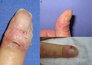 Presentación clínica del carcinoma epidermoide ungueal. Placas eritematodescamativas (A y B) y tejido similar a granulación (C) de localización periungueal.