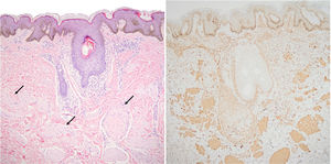Imagen histológica de la biopsia realizada en la paciente de 8 años. A la izquierda (hematoxilina-eosina ×10) se puede ver la presencia de múltiples fibras musculares lisas que se distribuyen en la dermis sin una orientación constante bajo una epidermis ligeramente acantósica. Se han señalado algunas de ellas con flechas negras. En la imagen de la derecha las fibras se tiñen con inmunohistoquímica para actina de músculo liso.