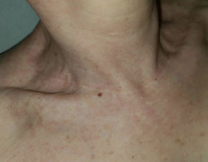 Ejemplo de resultado estético de las incisiones cutáneas orientadas horizontalmente al cuello. Esta gran cicatriz tiene su origen en una incisión lateral de una biopsia de ganglio que, tras muchos años, fue elongada anterior y medialmente para realizar una tiroidectomía total.