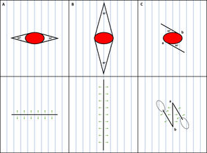 Opciones de sutura de un defecto quirúrgico elíptico (elipse roja) con su eje principal orientado contra las líneas principales de pliegue de la piel (MFL). A) Elipse más corta perpendicular a las MFL. B) Elipse de mayor tamaño paralela a las MFL. C) Z-plastia anticipada de 30°. Las líneas azules representan las MFL; las flechas verdes representan los vectores de la tensión; las elipses punteadas representan los conos de tejido excedente eventuales debidos a la Z-plastia.