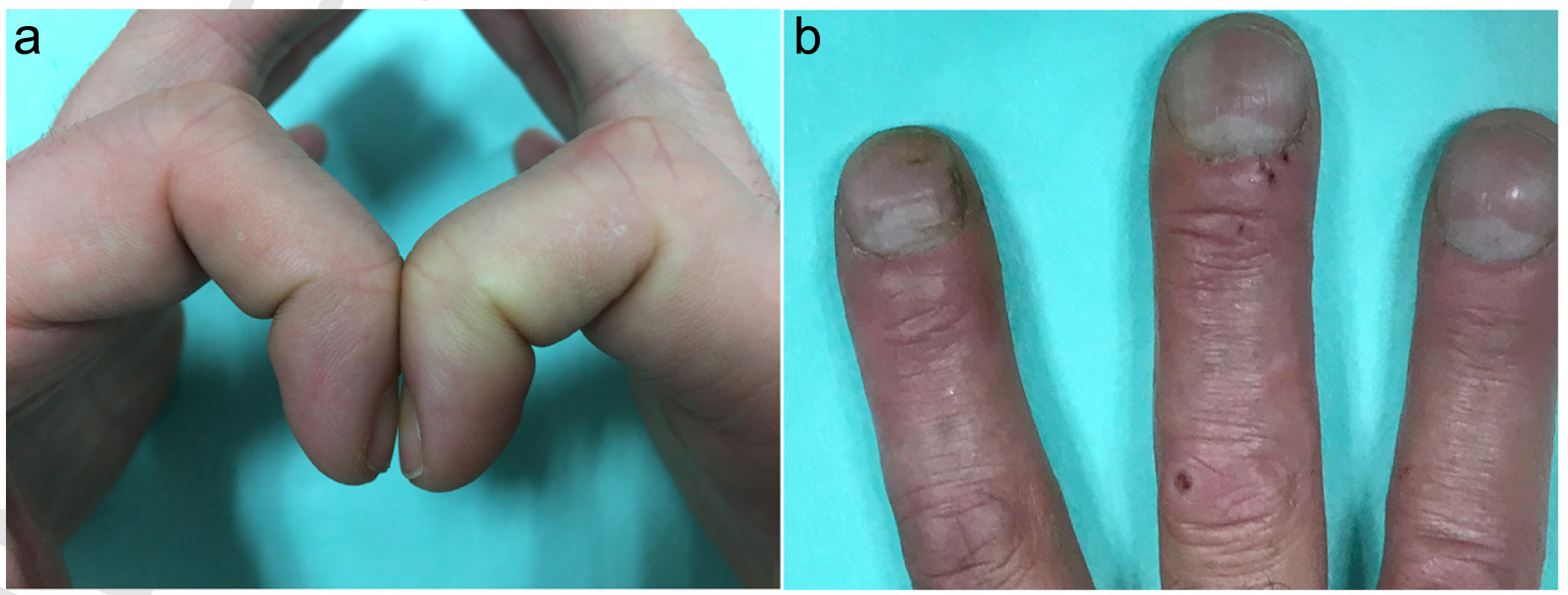 Figure 1 from A Takayasu's Arteritis Case with Unilateral Digital Clubbing  | Semantic Scholar