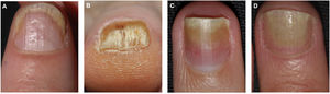 Clinical features of nail bed psoriasis. A, Splinter hemorrhages. B, Subungual hyperkeratosis. C, Oil drop. D, Onycholysis.