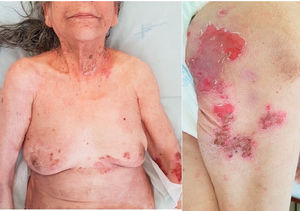 Clinical manifestations: multiple erosions present on the trunk, arms, neck, buttocks and thighs.