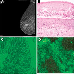 (A) Mamography showing a tumor on the right breast. (B) Histopathology showing vesicle formation with areas of subepidermal cleft formation, suprabasilar acantholysis and necrotic keratinocytes (hematoxylin and eosin [H&E]; original magnification ×200). (C) Direct immunofluorescence of perilesional skin demonstrating intercellular immunoglobulin G staining. (D) Indirect immunofluorescence demonstrating circulating immunoglobulin G antibodies binding to rat bladder epithelium.