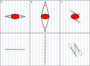Options to close an elliptical surgical defect (red ellipse) with its main axis oriented against the skin main folding lines (MFLs). A) Shorter ellipse perpendicular to the MFLs. B) Longer ellipse parallel to the MFLs. C) Anticipated 30̊ Z-plasty. Blue lines depict the MFLs; green arrows depict the vectors of tension; dotted ellipses depict the eventual standing cones due to Z-plasty.