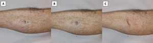 Circular excision of a highly suspicious melanocytic lesion. A) Classic elliptical excision following the lymphatic drainage. B) Circular excision without removing Burow