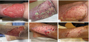 A, Initial defect after debriding of the wound margin. B, Removal of the lamellar graft with a dermatome. C, Placement of the graft on the wound bed: cuts are made to allow drainage of exudate. D, Negative pressure system on the graft, ensuring contact with the wound bed.