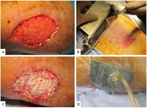 A, Initial defect in Patient 2, after improving the condition of the wound bed with negative pressure therapy prior to surgery. B, Initial defect in Patient 3. C and D, Appearance on day 5 after the intervention. E and F, Appearance on day 30 after the intervention.