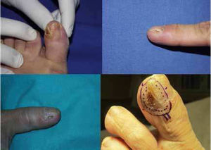 Nail bed abnormalities in nail squamous cell carcinoma. Onycholysis, hyperkeratosis, xanthonychia, or destruction of some of the lateral edges of the nail lamina.