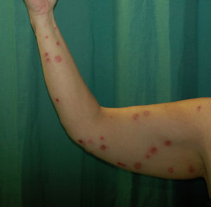 Erosive, crusted, nummular plaques of varying sizes, predominantly on the extremities.