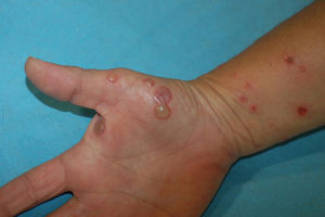 Tense blisters, some with clear and others with purulent content, on the hands.