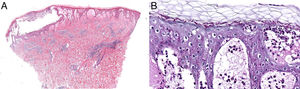Histology images. A, Acute spongiotic reaction pattern. B, Subcorneal blister containing neutrophils and periodic acid-Schiff-positive filamentous structures in the stratum corneum.