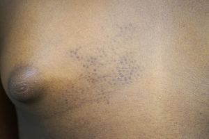 Clinical image of the patient's sister (10 years of age). The patient's follicular papules had progressively flattened over the preceding years.
