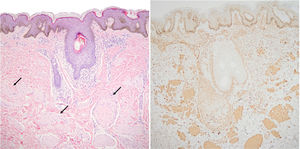 Histological image of the biopsy performed on the 8-year-old patient. A, Multiple smooth muscle fibers (black arrows) are distributed with no defined orientation in the dermis, beneath a slightly acanthotic epidermis (hematoxylin–eosin, original magnification ×10). B, Fibers stained for smooth muscle actin.