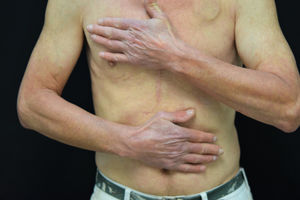 Sunburn-like rash in patient receiving hydrochlorothiazide treatment. Erythema with well-defined borders in photoexposed areas.