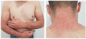 Ezcema-like rash Intense erythema, certain degree of scaling and intense signs of scratching limited to photoexposed areas. The patient started treatment with hydrochlorothiazide 4 months before onset of rash.