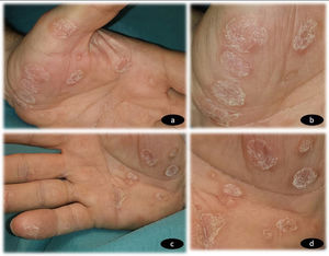 a) Placas hiperqueratósicas multifocales no confluyentes en palma de mano izquierda. b) Múltiples placas hiperqueratósicas de bordes bien definidos en palma de mano izquierda. c) Placas hiperqueratósicas multifocales no confluyentes en palma de mano derecha. d) Múltiples placas hiperqueratósicas de bordes bien definidos en palma de mano derecha.