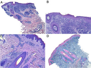 2A:x40 hematoxilina-eosina; 2B: x100 hematoxilina-eosina; 2C: x100 hematoxilina-eosina; 2D: x40 azul alcian.