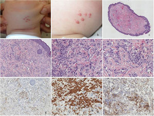 a y b) Imagen clínica; 7 pápulas de 2-3mm de diámetro en la mandíbula. c-f) H-E tumoración dérmica, sin contacto con la epidermis y patrón arquitectural arremolinado, constituida por células fusocelulares con núcleos ovoides monomorfos, sin atipia ni figuras de mitosis, sobre un estroma colágeno denso. g) MiTF positivo de forma difusa en los núcleos de las células neoplásicas. h) GLUT1 positivo intenso y difuso en las células neoplásicas. i) CD10 positivo citoplasmático y difuso en las células neoplásicas.