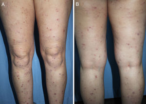 Nódulos escoriados de distribución simétrica en caras anterior (a) y posterior (b) de los miembros inferiores de una mujer de 42 años con antecedentes de dermatitis atópica.