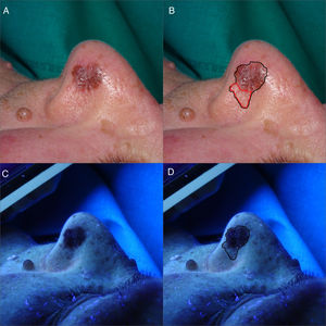 a y b. Imágenes clínicas de LMM en ala nasal izquierda. Mácula parduzca de 10×10mm con presencia de pseudorretículo pigmentado grueso. En color rojo, área pigmentada no visible clínicamente. c y d. Tras iluminación con luz de Wood se aprecia área pigmentada no visible de forma clínica. En color negro, margen quirúrgico definitivo de 25×18mm.