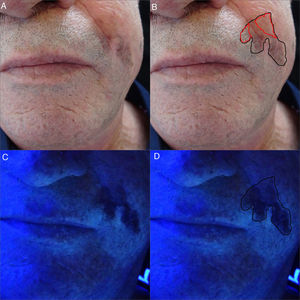 a y b. Imágenes clínicas de LM en surco nasogeniano izquierdo. Mácula hiperpigmentada mal delimitada de unos 2cm. En color rojo, área pigmentada no visible clínicamente. c y d. Tras iluminación con luz de Wood se aprecia área pigmentada no visible de forma clínica. En color negro, margen quirúrgico definitivo de 45×30mm.
