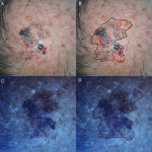 a y b. Imágenes clínicas de LMM en ápex craneal. Mancha hiperpigmentada heterogénea con zonas nodulares, mal delimitada en ápex craneal, de unos 3cm. En color rojo, área pigmentada no visible clínicamente. c y d. Tras iluminación con luz de Wood se aprecia área pigmentada no visible previamente. Referenciado en color negro el margen quirúrgico definitivo de 45×35mm.