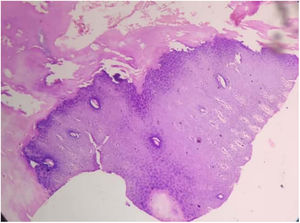 Massive hyperkeratosis, hypergranulosis and acanthosis in the epidermis (H&E; 100×).