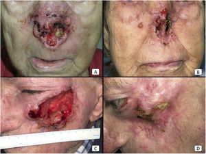 Cases 12 (A, B) and 2 (C, D). (A, B): Locally advanced cSCC in the nose of an elderly woman. There is a dramatical reduction of the tumor bulk after only 2 cycles of cemiplimab (B). (C, D): Locally advanced cSCC of the left cheek in an elderly man. Before starting therapy, the patient presented a large, ulcerated tumor (C). After 10 cycles, the patient showed a complete treatment response, with complete clearance of the tumoral mass and secondary maxillary bone exposure.