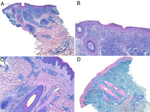 Hematoxylin–eosin staining, original magnification ×40 (A); ×100 (B, C). D, Alcian blue, original magnification ×40.