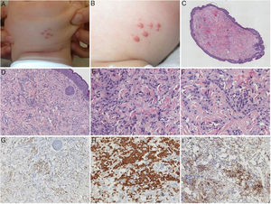 A and B) Clinical image showing 7 papules of 2–3mm diameter on the jaw. C–F) Histological images (hemoxylin–eosin) show a dermal tumor with no epidermal involvement and a whorled architectural pattern, consisting of spindle cells with monomorphic ovoid nuclei, without atypia or mitotic figures, in a dense collagen stroma. G) Diffuse microphthalmia transcription factor (MiTF)-positive staining in the nuclei of neoplastic cells. H) Intense, diffuse GLUT1-positive staining in neoplastic cells. I) Diffuse and cytoplasmic CD10-positive staining in neoplastic cells.