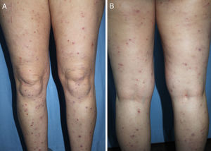 Symmetrically distributed excoriated nodules on the legs of a 42-year-old woman with a history of atopic dermatitis. A, Anterior surface. B, Posterior surface.