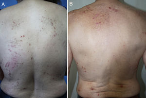 A, Pruritus with nodular and linear type lesions and linear excoriations that spare the central portion of the back. B, Pruritus with nodular lesions forming the butterfly sign on the back.
