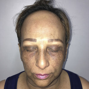 Hyperpigmented macules on the face.