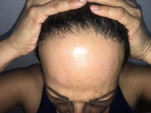 Frontotemporal alopecia with hairline recession.