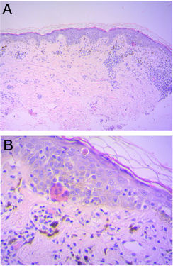 Vacuolar interface dermatitis with the presence of melanophages in the dermis: hemoxylin–eosin, original magnification ×10 (A) and ×40 (B).
