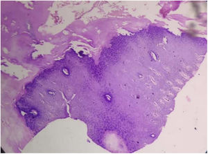 Amplia hiperqueratosis, hipergranulosis y acantosis en la epidermis (H&E, ×100).