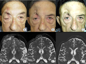 Caso 8: cSCC avanzado con invasión orbital, invasión perineural clínica, y metástasis ganglionares regionales. (A-C): fotografías clínicas del paciente antes de iniciar la terapia, tras 2 ciclos, y tras 8 ciclos, respectivamente. En (A), existe ptosis obvia del párpado derecho debido a la invasión perineural tumoral. (D-F): imágenes de RM ponderadas en T2 antes de iniciar la terapia, tras 4 ciclos, y tras 18 ciclos, respectivamente. La masa grande frontal observada en (D) ha desaparecido completamente en (F) lo cual refleja, por tanto, la respuesta completa al tratamiento.