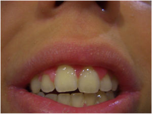 Excellent cosmetic result after treatment with CO2 laser.