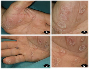 A, Multifocal noncoalescing hyperkeratotic plaques on the palm of the left hand. B, Multiple hyperkeratotic plaques with well-defined edges on the palm of the left hand. C, Multifocal noncoalescing hyperkeratotic plaques on the palm of the right hand. D, Multiple hyperkeratotic plaques with well-defined edges on the palm of the right hand.