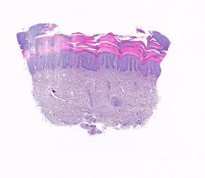 Epidermal acanthosis and hypergranulosis (hematoxylin–eosin, ×10). Little perivascular inflammatory infiltrate.