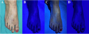 Linear cutaneous hypopigmentation following local injection of corticosteroids in patient 1. A) Clinical presentation of the lesions under ambient lighting. B) Blue coloring of the lesions using the conventional Wood
