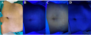 Progressive and coalescing macular hypomelanosis in patient 2. A) Clinical presentation of the lesions under ambient lighting. B) Blue coloring of the lesions using the conventional Wood